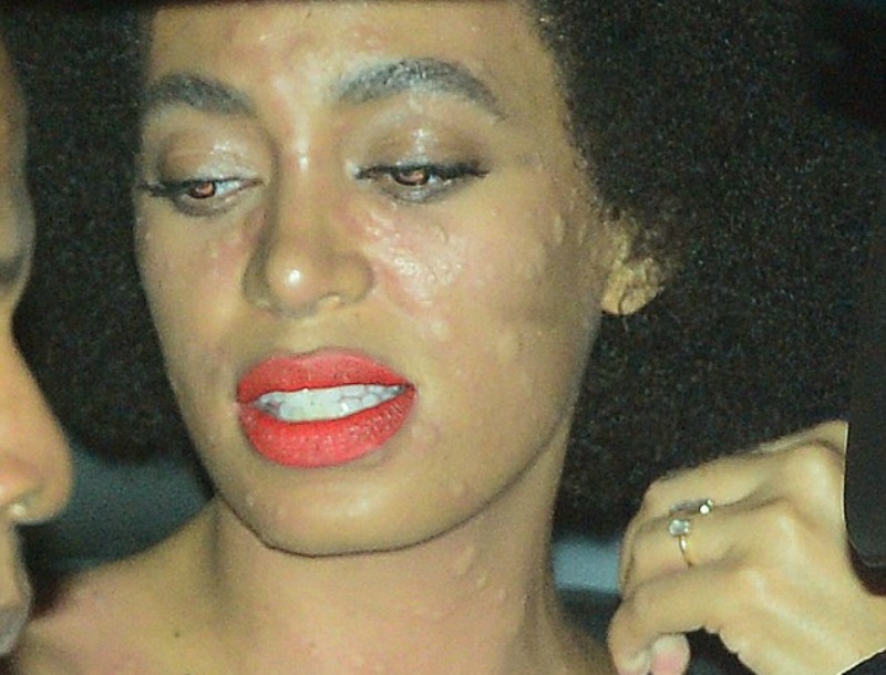 Απίστευτη αλλεργία! Η Solange Knowles γέμισε σπυράκια στον γάμο της