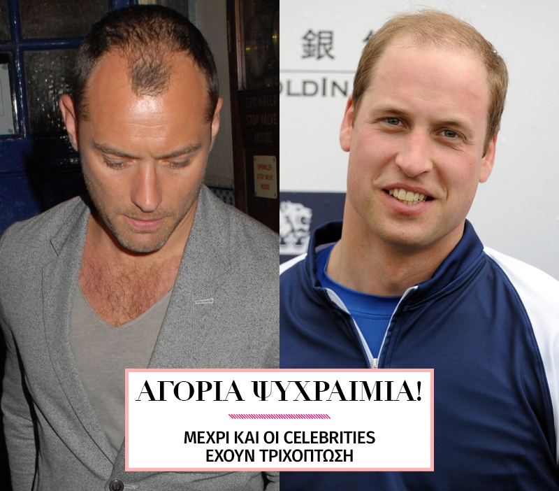 Τριχόπτωση; Και οι celebrities έχουν τα προβλήματά τους Τριχόπτωση; Και οι celebrities έχουν τα προβλήματά τους